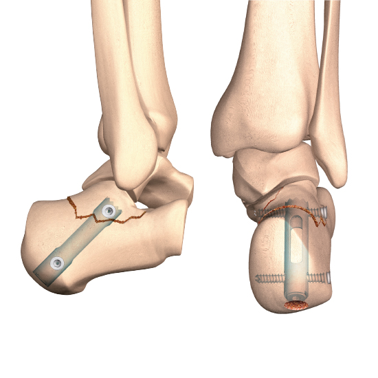 calcanail for calcaneal fracture and subtalar arthrodesis